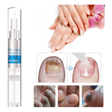 Charger l&#39;image dans la galerie, Stylo de réparation Onychomycose